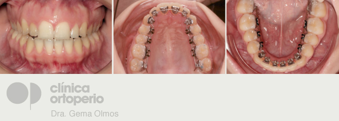 Aparatos de ortodoncia invisibles2