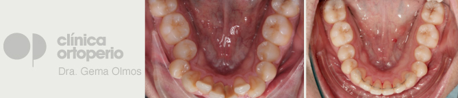 Aparatos de ortodoncia invisibles3