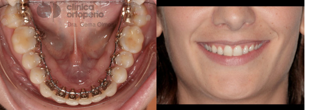 ortodoncia lingual